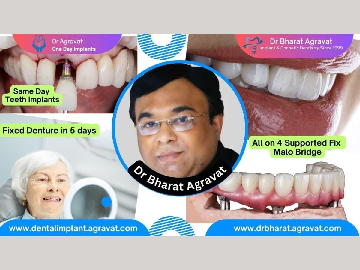 Best Dentist for Full Mouth Dental Implants Clinic in Ahmedabad: Dr. Bharat Agravat, the top Implantologist