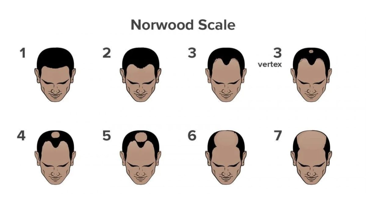 What is Causing Your Hair Fall? Take This Scientifically Backed Hair Loss Quiz